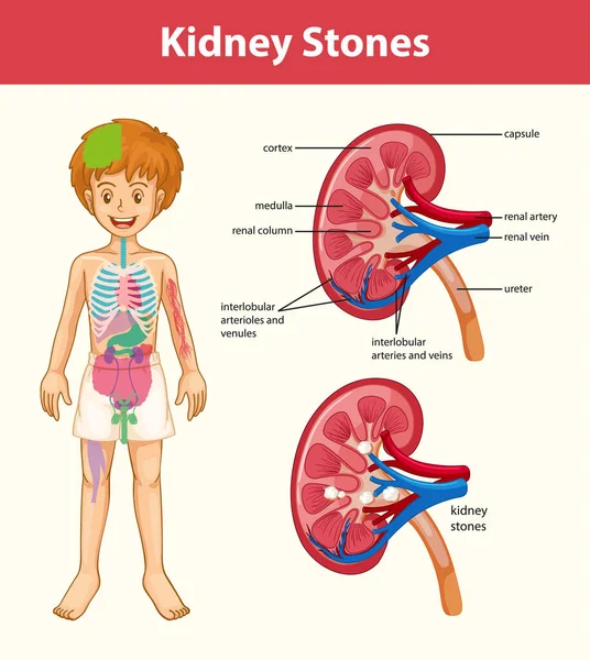 Cálculos Renales Síntomas Dibujos Animados Estilo Infografía Ilustración — Archivo Imágenes Vectoriales