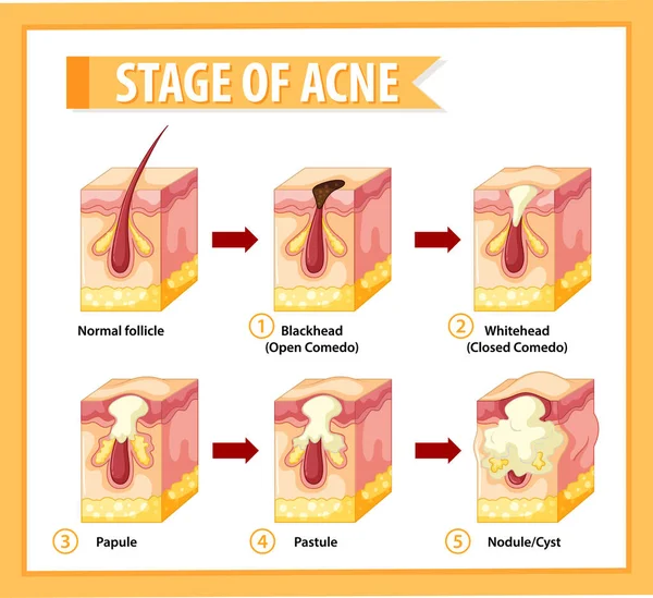 Estágios Ilustração Anatomia Acne Pele —  Vetores de Stock