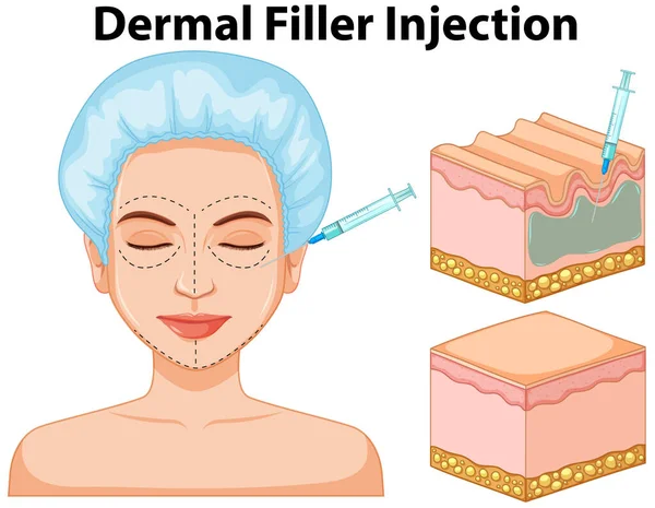 Illustrazione Delle Informazioni Sull Iniezione Filler Dermico — Vettoriale Stock