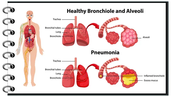 人类肺的健康和不健康说明 — 图库矢量图片