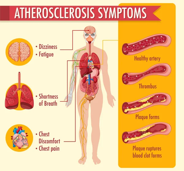 Stages Atherosclerosis Information Infographic Illustration — 스톡 벡터
