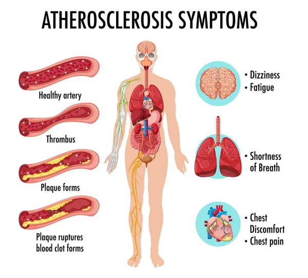Stages Atherosclerosis Information Infographic Illustration — Stock Vector