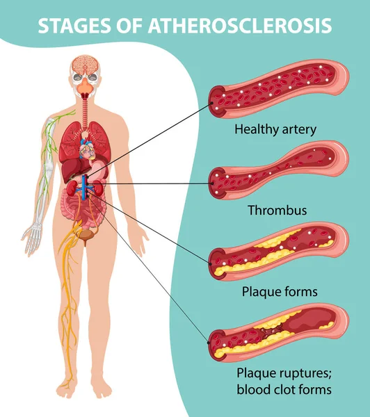 Etapas Información Aterosclerosis Ilustración Infográfica — Vector de stock