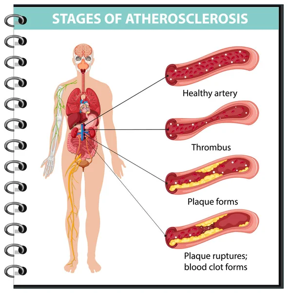 Stupně Aterosklerózy Informace Infografické Ilustrace — Stockový vektor