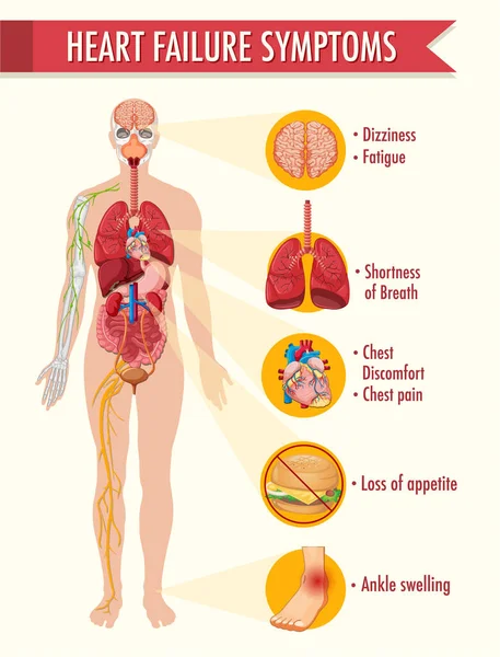 Insuficiencia Cardíaca Síntomas Información Ilustración Infografía — Archivo Imágenes Vectoriales