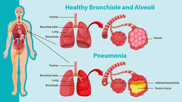 人間の肺のイラストの健康と不健康な — ストックベクタ