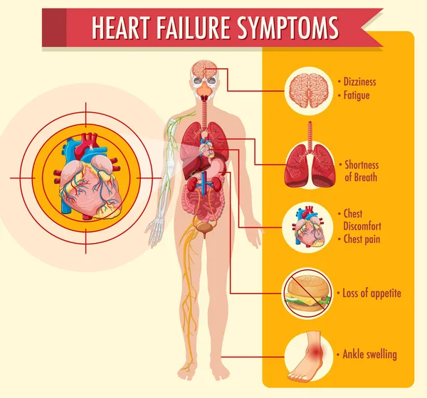 Insuficiencia Cardíaca Síntomas Información Ilustración Infografía — Archivo Imágenes Vectoriales