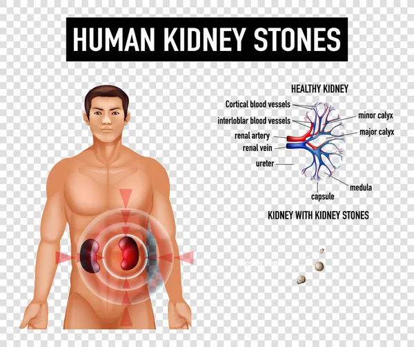 透明な背景図にヒト腎臓結石を示す図 — ストックベクタ