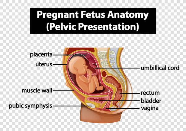 Anatomia Feto Grávida Apresentação Pélvica Ilustração — Vetor de Stock