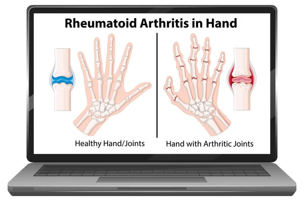 Συμπτώματα Ρευματοειδούς Αρθρίτιδας Στο Χέρι Στην Απεικόνιση Οθόνης Laptop — Διανυσματικό Αρχείο