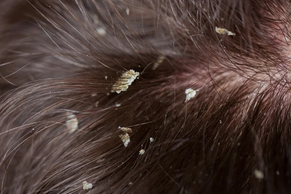 Caspa no cabelo. O quê? Escamoso couro cabeludo . — Fotografia de Stock