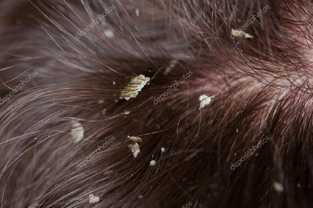 Dandruff in the hair. Flaky scalp. Stock Photo by ©Vitalinka 101785464