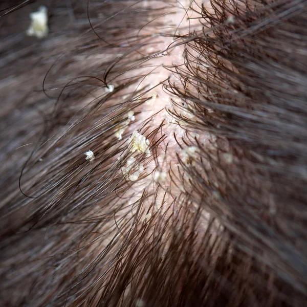 Dandruff in the hair. Flaky scalp. — Stock Photo, Image