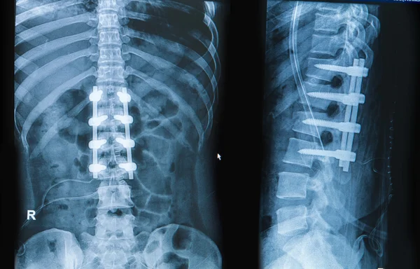 Radiografia de dor nas costas mostra coluna vertebral com fusão do implante — Fotografia de Stock