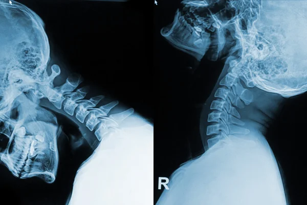 X-ray foto van nek nekpijn in flex en exten positie weergeven — Stockfoto