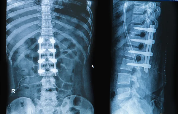 Röntgenbild von Rückenschmerzen zeigt Wirbelsäule mit Implantatfusion lizenzfreie Stockbilder