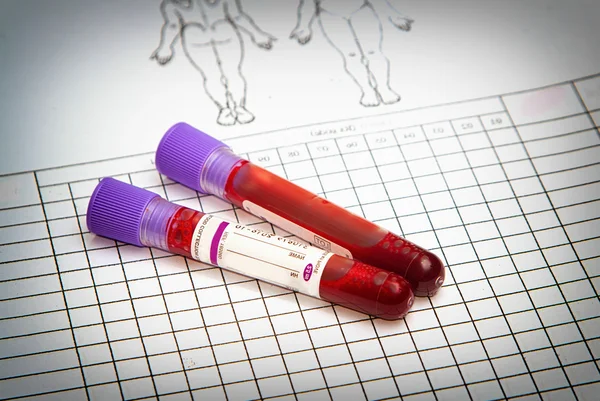 Frasco de sangue com amostra de sangue no formulário de registo — Fotografia de Stock
