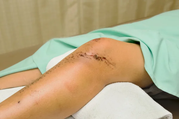 Сшитое ранение после операции на колене и ноге — стоковое фото