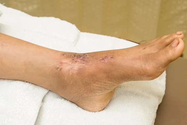 Sutura da ferida do tornozelo — Fotografia de Stock