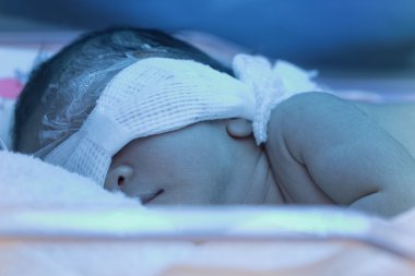Mavi Uv phot için ışığı altında yenidoğan sarılığı ile yeni doğan bebek
