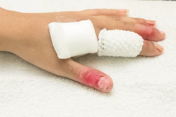 Gewonde vinger verpakt in een gaas verband na de operatie — Stockfoto