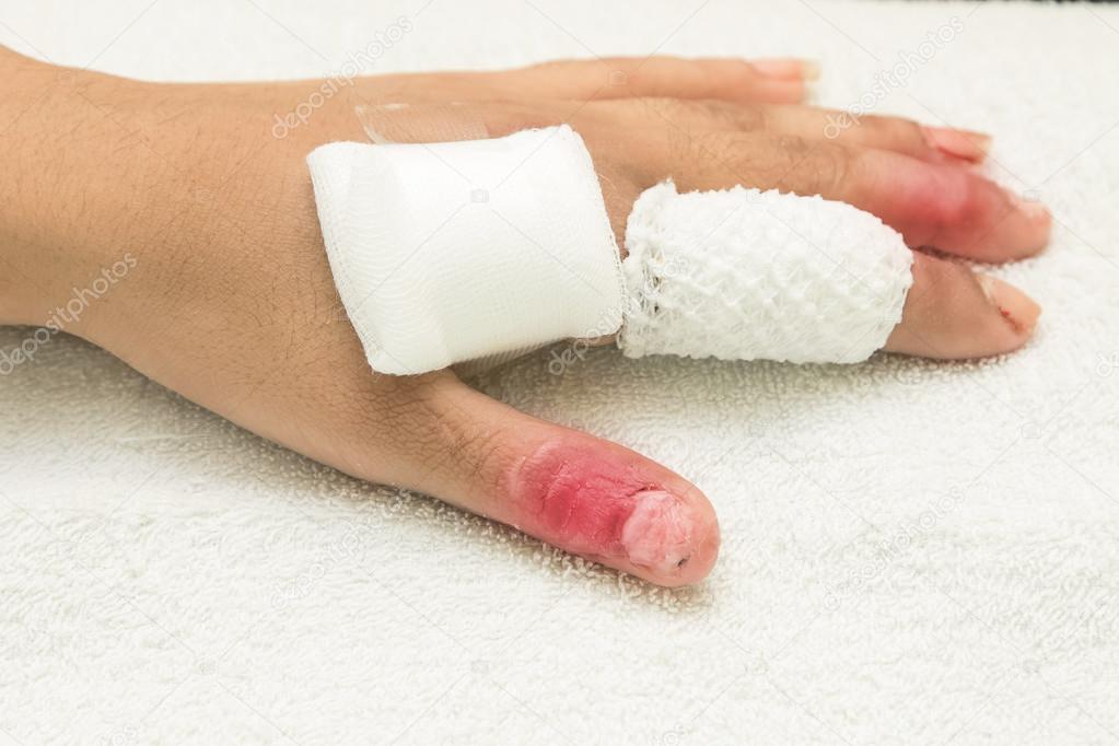 Injured finger wrapped in a gauze bandage after surgery Stock Photo by ©plepraisaeng 72618297