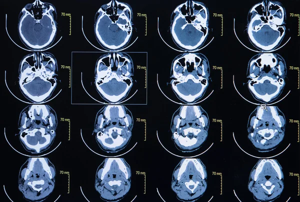 Series of images from a computerized tomography of the brain — Stock Photo, Image