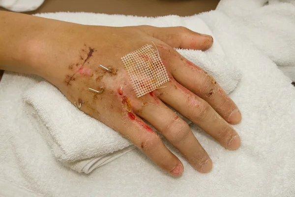 Primer plano de una mano fracturada con fijación de pasador en la mano —  Fotos de Stock