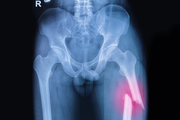 治疗股骨骨折断的大腿 x 射线图像 — 图库照片