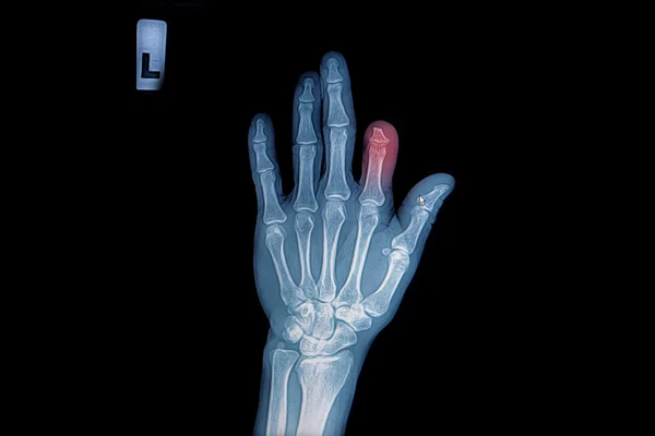 X-ray of trauma hand and finger — Stock Photo, Image