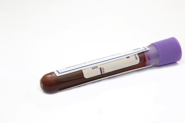 Blood sample for analysis in the laboratory — 스톡 사진