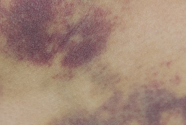 Closeup on a Bruise on wounded woman leg skin clipart