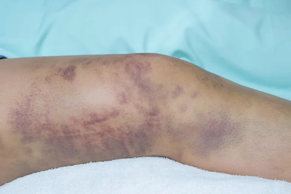 Close-up em um hematoma na pele da perna da mulher ferida — Fotografia de Stock