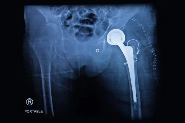 X-ray of the hip endoprosthesis in elderly woman, Total hip repl