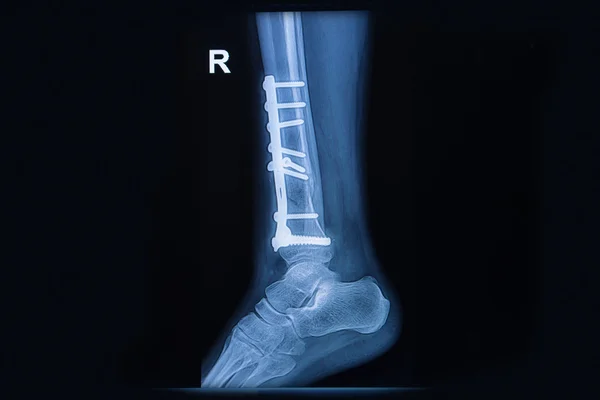 Film x-ışını ayak bileği kırığı distal tibia göster — Stok fotoğraf