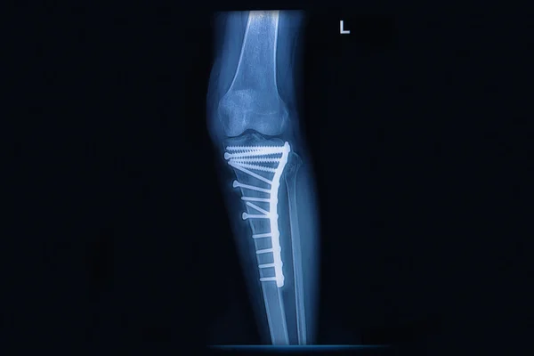 Radiografía de fractura tibia (hueso de la pierna). hueso tibia con fijación interna — Foto de Stock