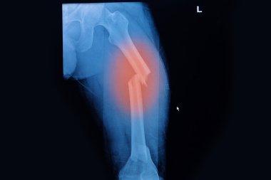 Fractured Femur, Broken leg x-rays image clipart