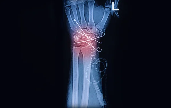 X-ray image of wrist joint, Showing radius fracture with k wire — Stock Photo, Image