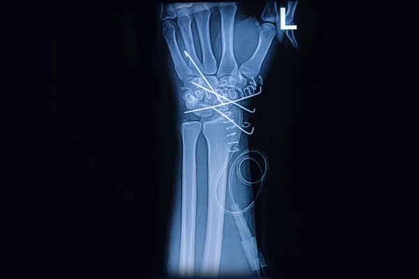 Röntgenbild des Handgelenks, zeigt Radiusfraktur mit k-Draht — Stockfoto
