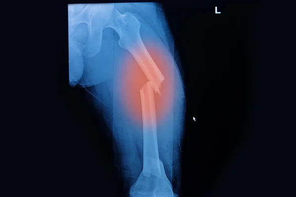 Fémur fracturado, imagen de rayos X de piernas rotas — Foto de Stock