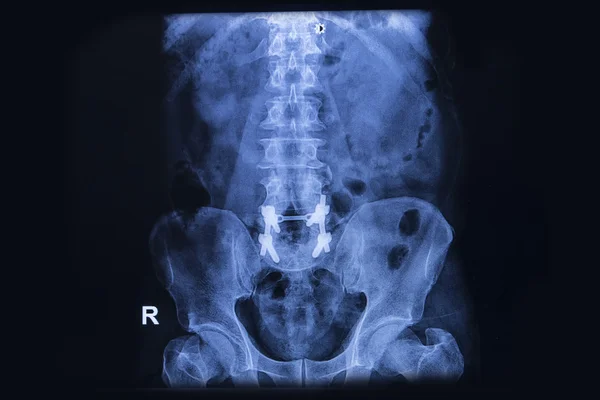 Lumbar Osteosynthesis ,lumbar spinal column with internal fixati — Stock Photo, Image