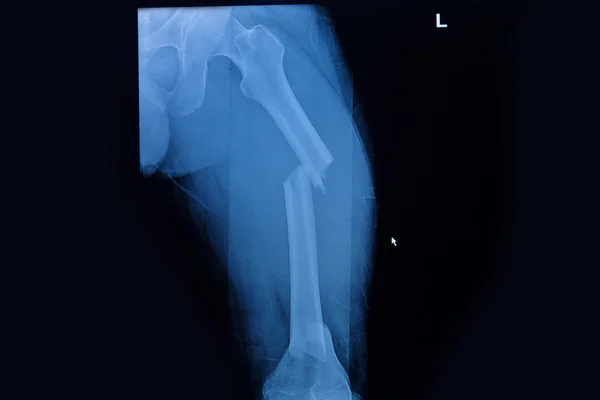 Fractured Femur, Broken leg x-rays image — Stock Image Fractured Femur, Broken leg x-rays image Royalty Free Stock Photos