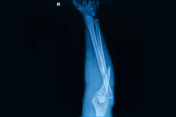 Collection of human x-rays  showing fracture  of  radius  bone — Stock Photo, Image