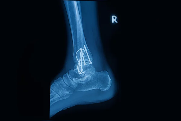 Колекція рентгенівських променів людини, що показують перелом правої ноги (фракція — стокове фото