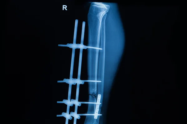 Collection of human x-rays  showing fracture of right leg ,  pos — Stock Photo, Image