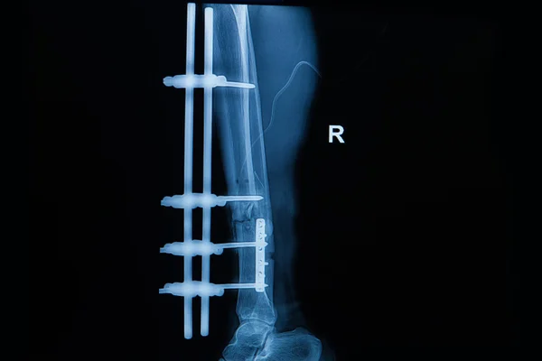Sammlung menschlicher Röntgenbilder, die eine Fraktur des rechten Beins zeigen, — Stockfoto