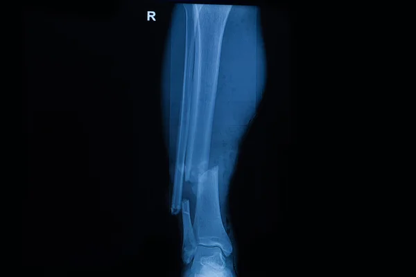 人类的集合 x 光片显示骨折的右腿 — 图库照片