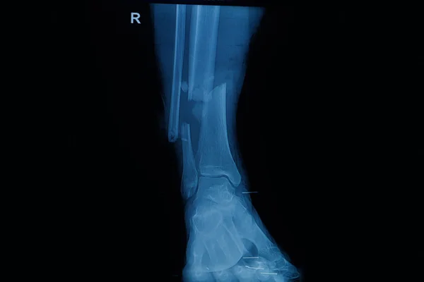 人类的集合 x 光片显示骨折的右腿 — 图库照片