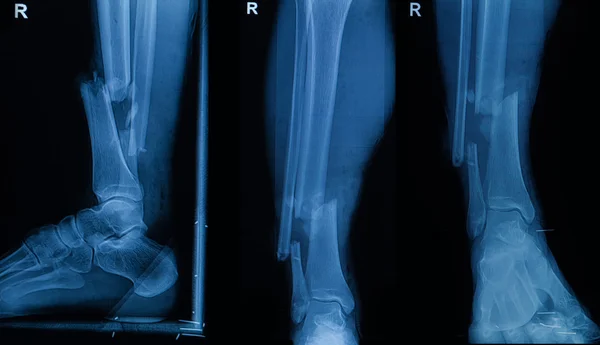 Kolekcja człowieka rentgenowskie wyświetlone złamania prawej nogi (frac — Zdjęcie stockowe
