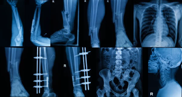 Collection of  X-ray , Multiple part of adult  show fracture bon — Stock Photo, Image